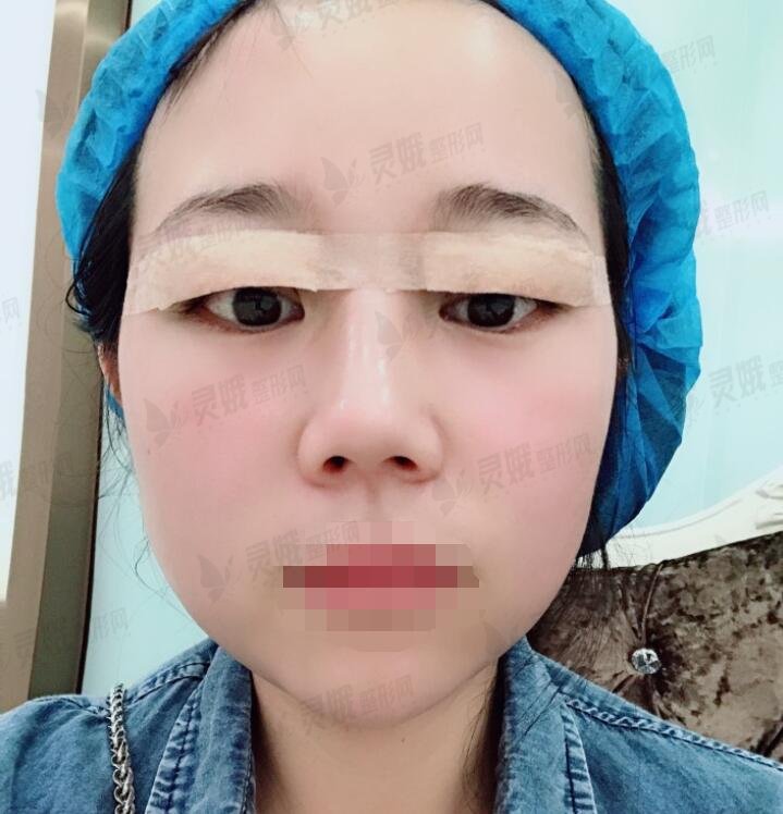 8毫米双眼皮术后一周