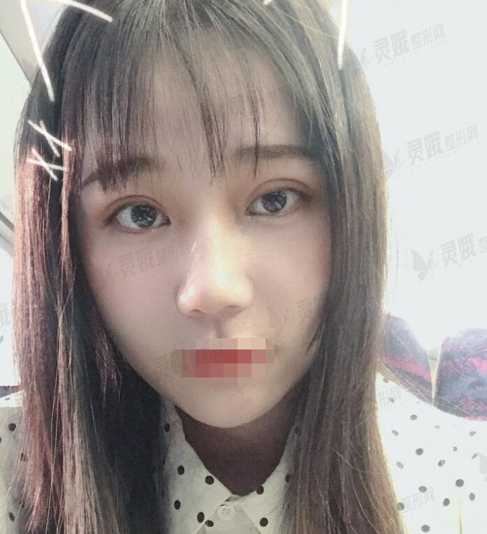 8毫米双眼皮术后一个月