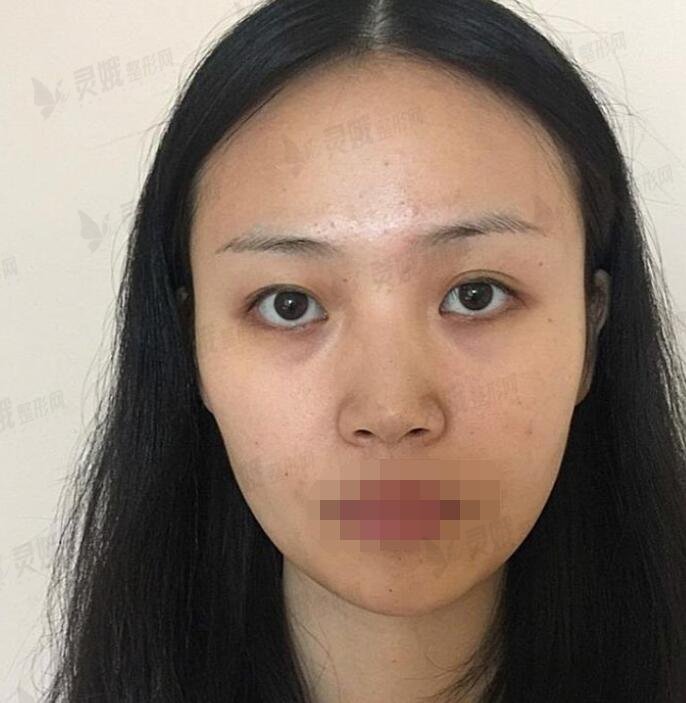 重医贺光照隆鼻前