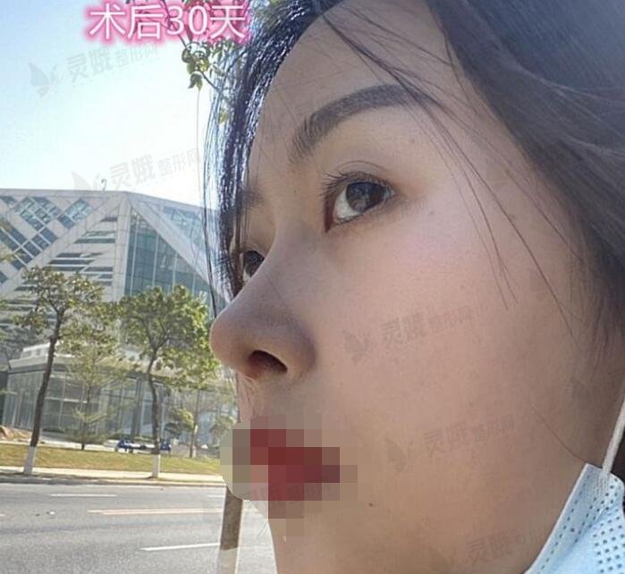 重医贺光照隆鼻后30天