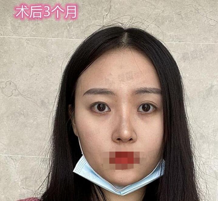 重医贺光照隆鼻后3个月