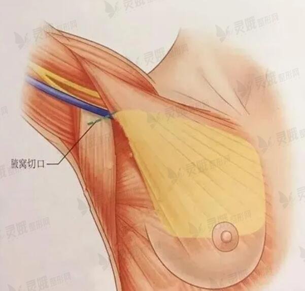 做完隆胸术后应该怎么护理