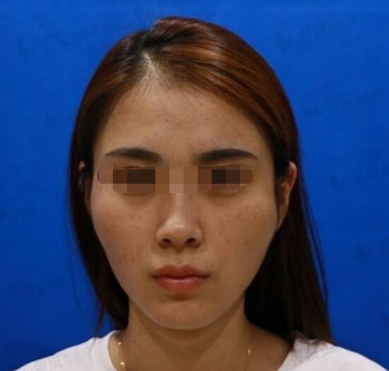 削骨手术亲身经历：术前高颧骨“巫婆脸”，术后柔美“清纯脸”~