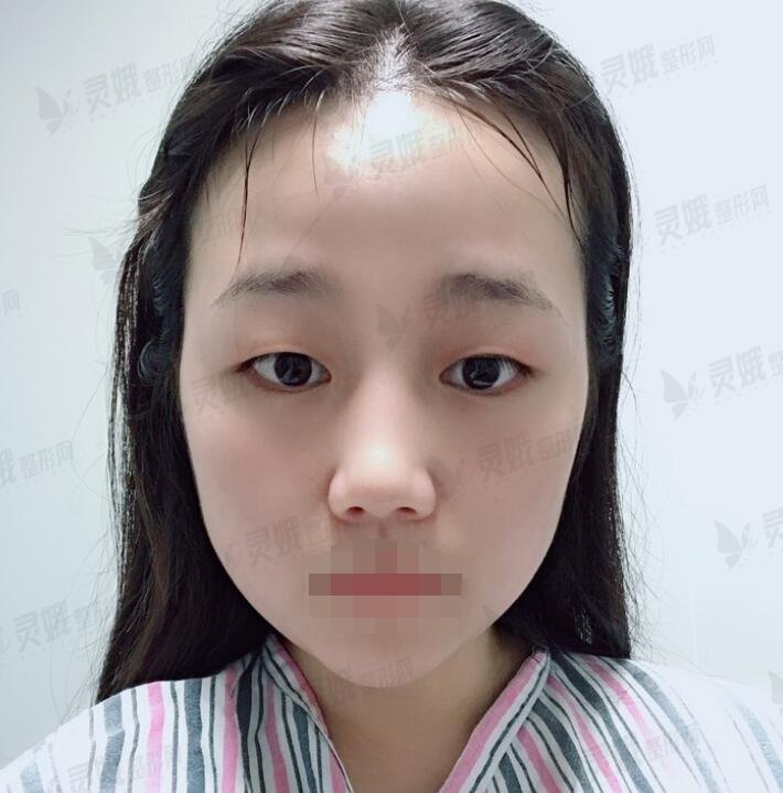 双眼埋线恢复七天图：埋线双眼皮恢复过程记录，及术后果参考~