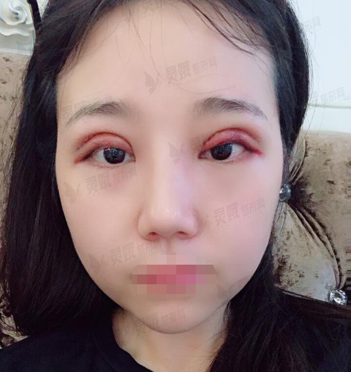 双眼埋线术后3天