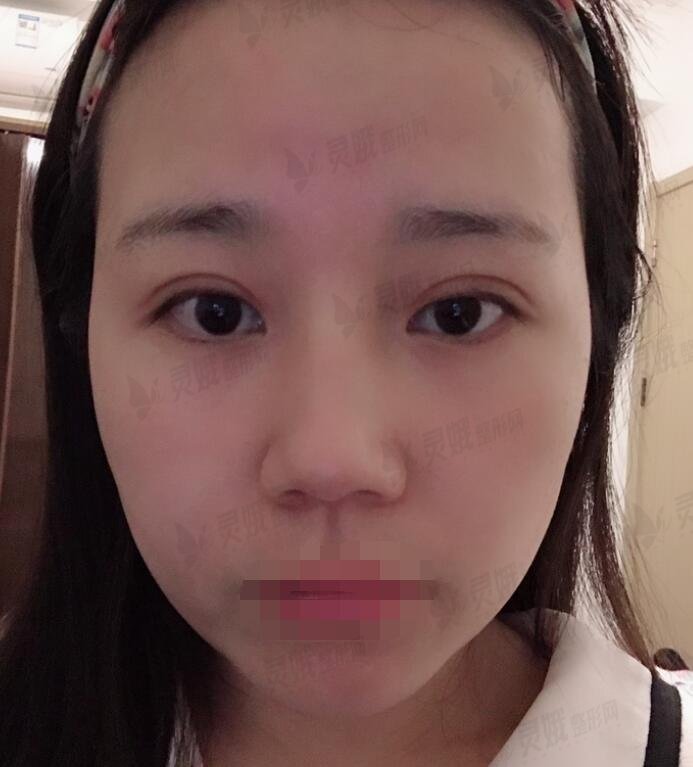 术后果