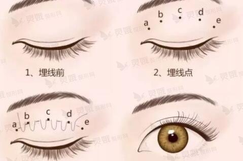 埋线双眼皮