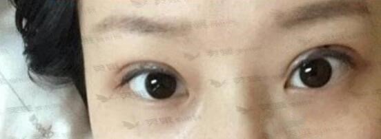 微创双眼皮后半个月
