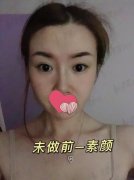 开眼角对比果图：术后3个月恢复果展示及恢复过程记录~
