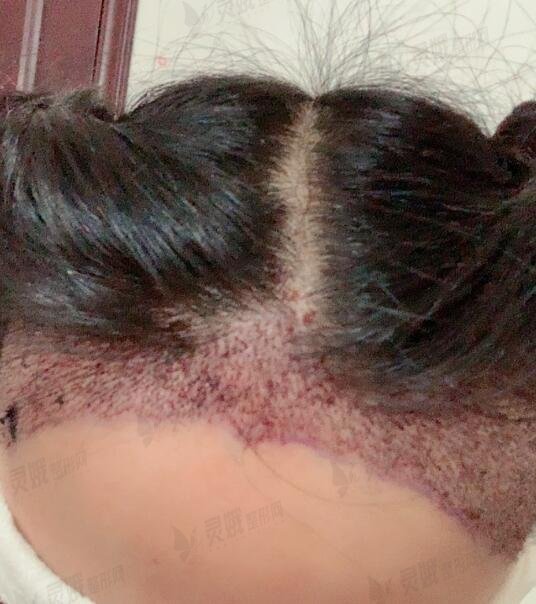 佛山市第一人民医院美容科毛发种植手术后