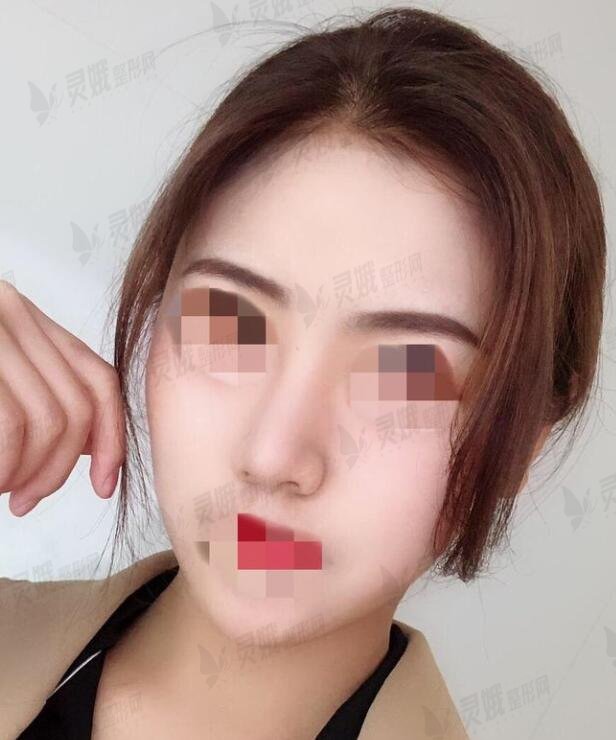 陈辉医生隆鼻手术后一个月