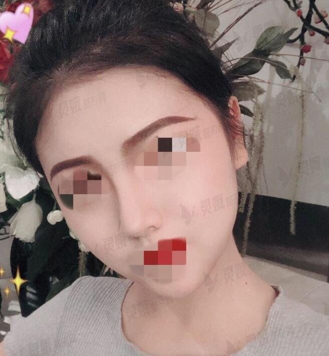 陈辉医生隆鼻手术后果