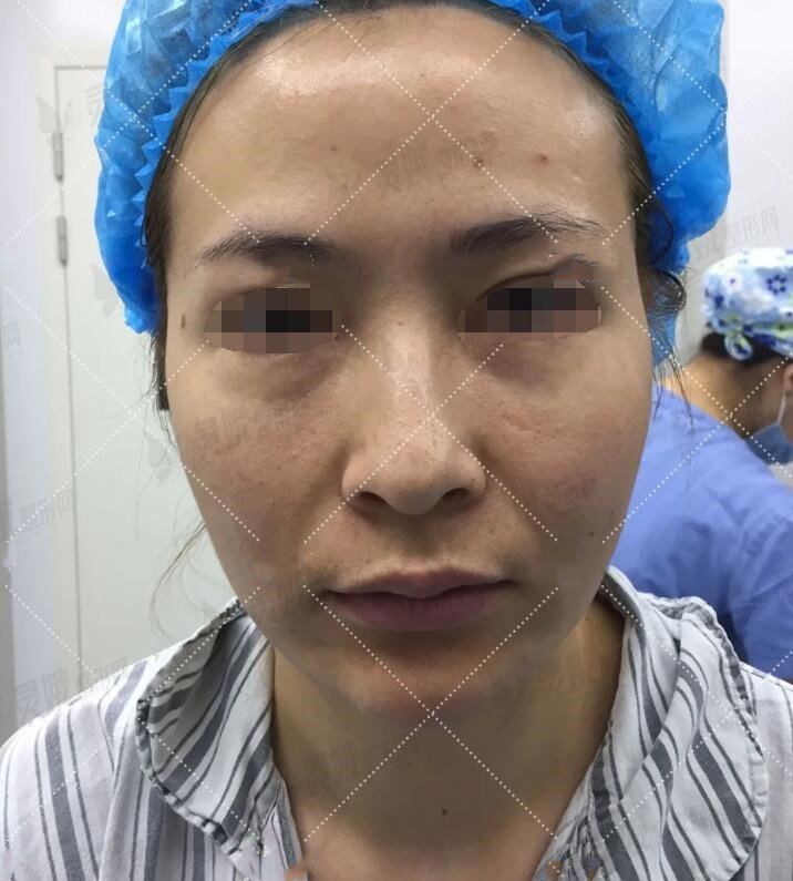 暨南大学医院美容外科冰电波除皱手术前