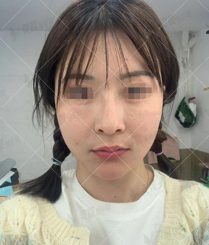 暨南大学医院美容外科冰电波除皱手术后
