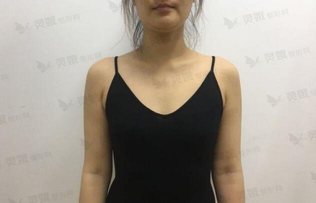 刘涛医生丰胸手术前