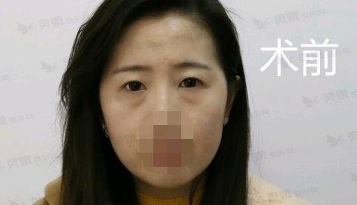 梁锋医生去眼袋手术前