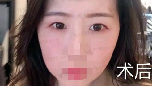 梁锋医生去眼袋手术后