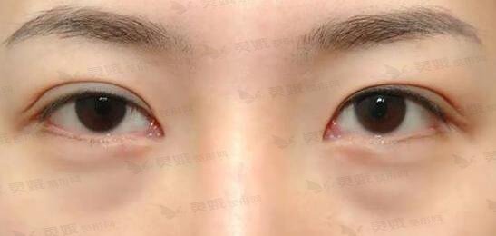 激光去眼袋果好吗