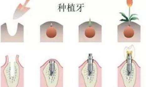 牙齿种植hg002.jpg