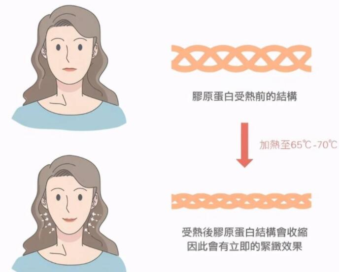 电波拉皮除皱的价格，揭晓相关问题，性价比高值得选