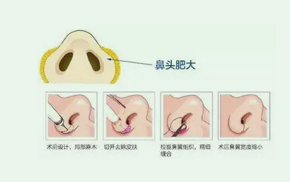 鼻翼整形对比前后果图差距有多大?鼻翼整形的原理和价格通通一键收藏吧!
