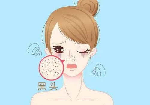 鼻子上的黑头怎么去掉？有哪些好的方法？