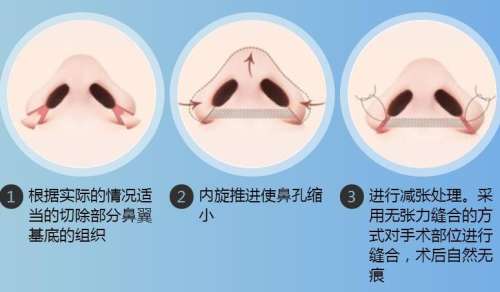 鼻翼缩小.jpg